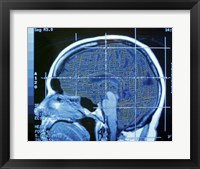 Framed Close-up of an MRI scan of the human brain